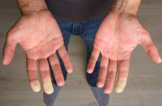 Хвороба пальців рук: симптоми, діагностика та лікування