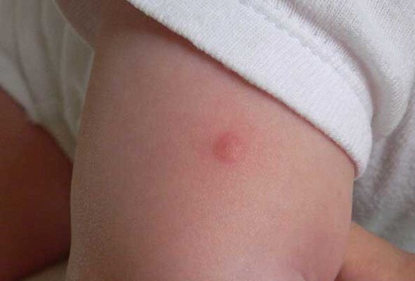 Укус комара у дитини: як захистити малюка і зменшити свербіж