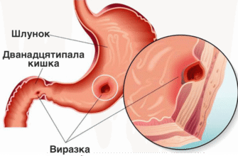 Що таке виразка шлунка? Причини, симптоми та лікування
