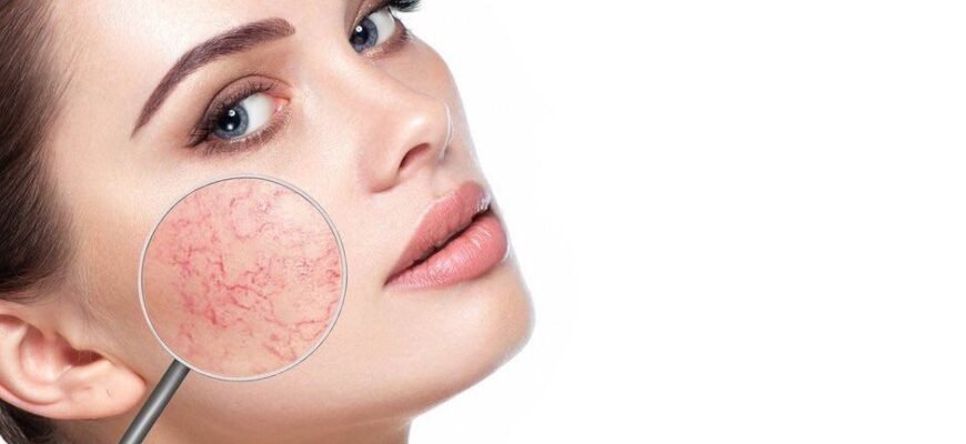 Що таке капіляри: визначення та їх роль у кровообігу людини Що таке капіляри: визначення та їх роль у кровообігу людини