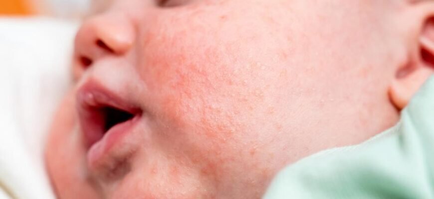 Причини та лікування: висип на обличчі у дитини – що робити?