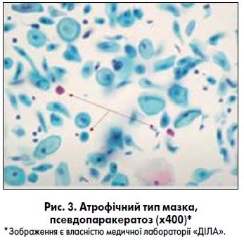 Тип 2 реактивні зміни клітин плоского епітелію: що варто знати Тип 2 реактивні зміни клітин плоского епітелію: що варто знати