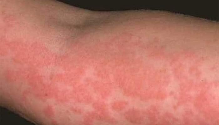 Дерматит: як лікувати шершаві плями на шкірі у дитини ефективно?