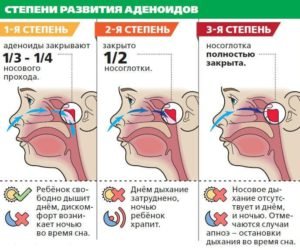 Кашель при аденоїдах у дитини: причини, симптоми, лікування Кашель при аденоїдах у дитини: причини, симптоми, лікування