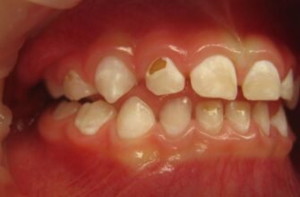 Причини та методи усунення жовтого нальоту на зубах у дитини