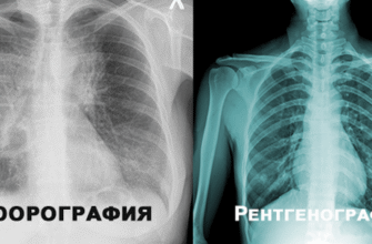 Флюорографія і рентген: в чому різниця між цими методами?