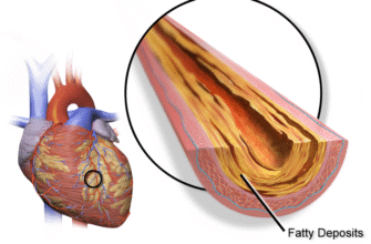 Ішемічна хвороба серця МКХ 10: причини, симптоми та лікування