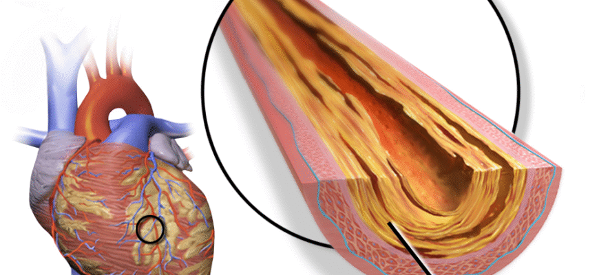 Ішемічна хвороба серця МКХ 10: причини, симптоми та лікування