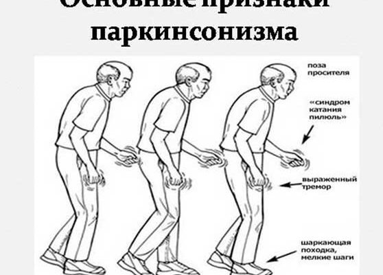Що таке хвороба Паркінсона: симптоми, причини та лікування