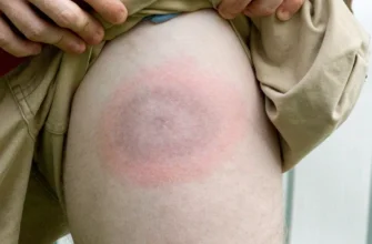 Хвороба Лайма: перші ознаки, на які варто звернути увагу