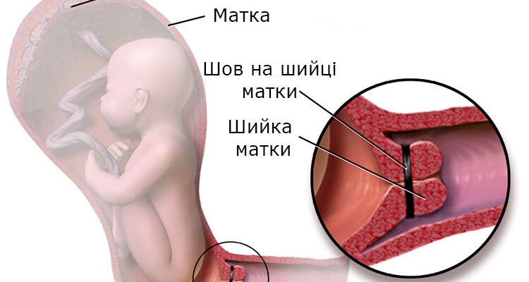 Шийка матки при вагітності: особливості змін і важливість моніторингу