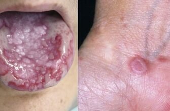 Котячий лишай у дитини: симптоми, діагностика та лікування