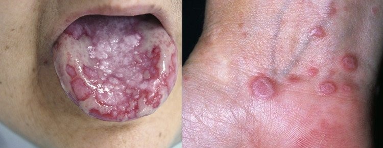 Котячий лишай у дитини: симптоми, діагностика та лікування Котячий лишай у дитини: симптоми, діагностика та лікування