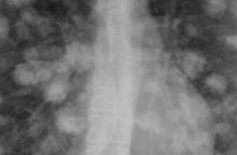 Що таке вузли в легенях: розуміння причин та діагностики