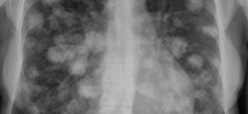 Що таке вузли в легенях: розуміння причин та діагностики Що таке вузли в легенях: розуміння причин та діагностики