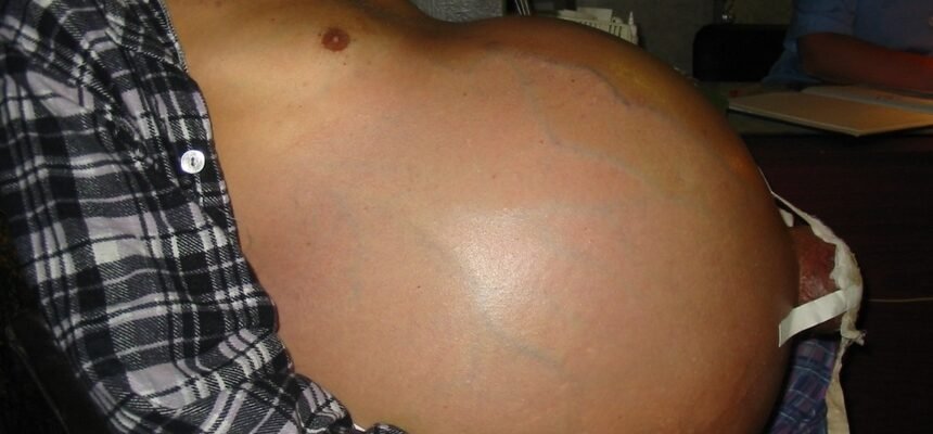 Живот при циррозе печени: фото змін і симптоми патології