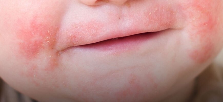 Дерматит: Шершаві Плями на Шкірі у Дитини – Фото та Роз’яснення Дерматит: Шершаві Плями на Шкірі у Дитини – Фото та Роз’яснення