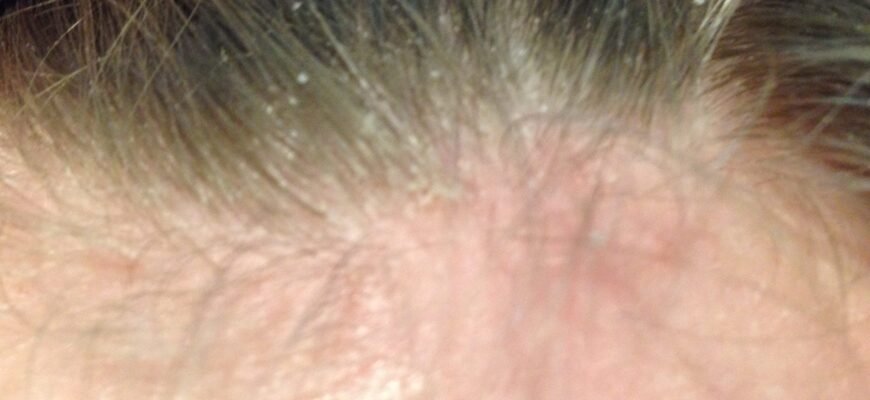 Лусочки на голові у дитини 6 років: причини та способи боротьби Лусочки на голові у дитини 6 років: причини та способи боротьби