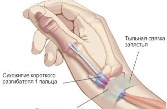 Хвороба де Кервена: причини, симптоми та методи лікування