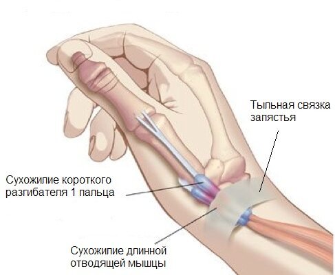 Хвороба де Кервена: причини, симптоми та методи лікування Хвороба де Кервена: причини, симптоми та методи лікування