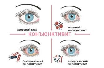 Кон’юнктивіт у дітей: чи можна гуляти під час лікування?