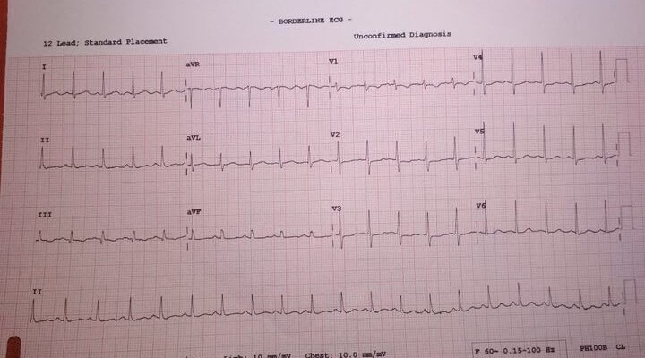 Дистрофічні зміни міокарда: причини, симптоми та лікування Дистрофічні зміни міокарда: причини, симптоми та лікування