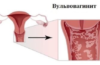 Як виглядає вульвовагініт у дитини: симптоми, причини та лікування