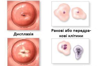 Стаття: Тип 2 реактивні зміни — запальний тип мазку та його аналіз