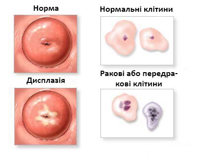 Стаття: Тип 2 реактивні зміни — запальний тип мазку та його аналіз Стаття: Тип 2 реактивні зміни — запальний тип мазку та його аналіз