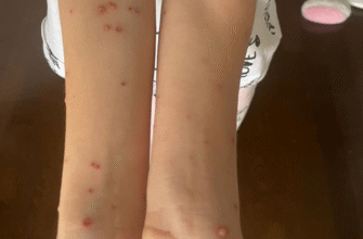 Вітрянка у дитини: симптоми, лікування та профілактика захворювання