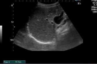 Дифузні зміни паренхіми печінки: причини, симптоми та лікування