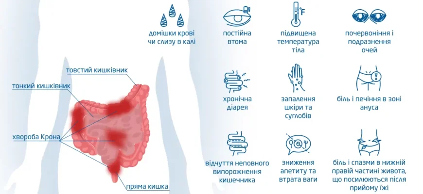 Хвороба Крона: ефективне лікування народними методами