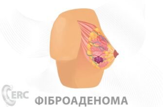 Фіброзні зміни в грудях: причини, симптоми та лікування