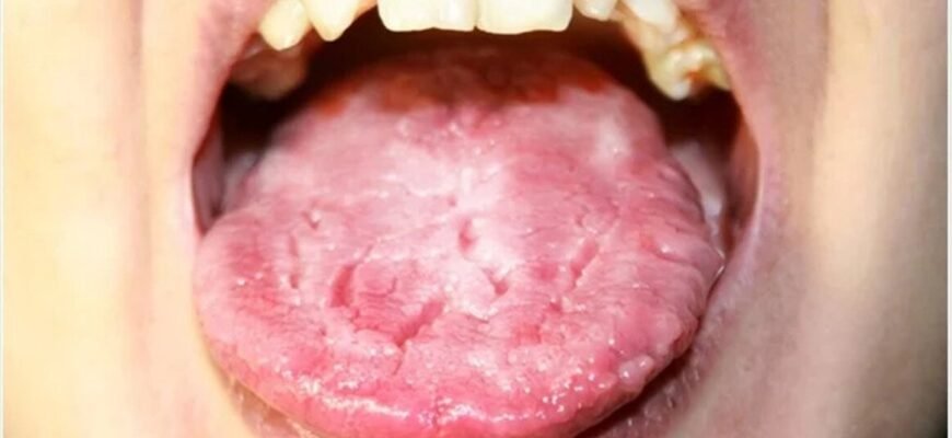 Як приймати флуконазол при кандидозі ротової порожнини: поради лікарів