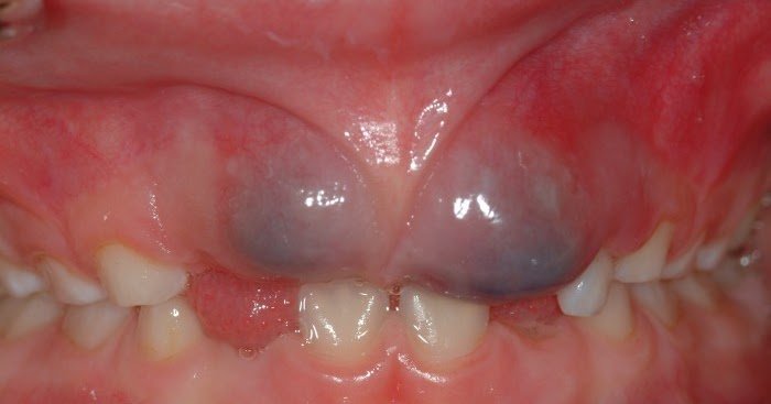 Симптоми та лікування флюсу у дитини: поради для батьків Симптоми та лікування флюсу у дитини: поради для батьків