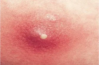 Що таке фурункул? Детальне пояснення причин і симптомів.