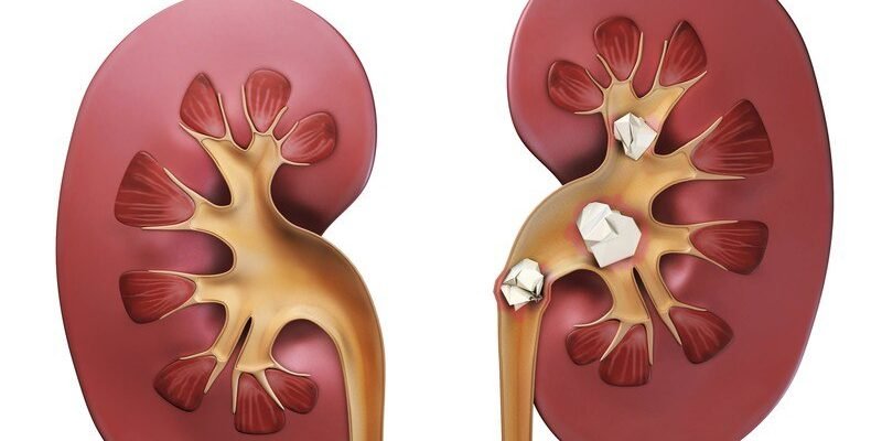 Сечокам’яна хвороба влк: причини, симптоми та лікування