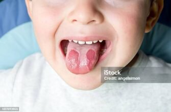 Географічний язик у дитини: причини, симптоми та лікування