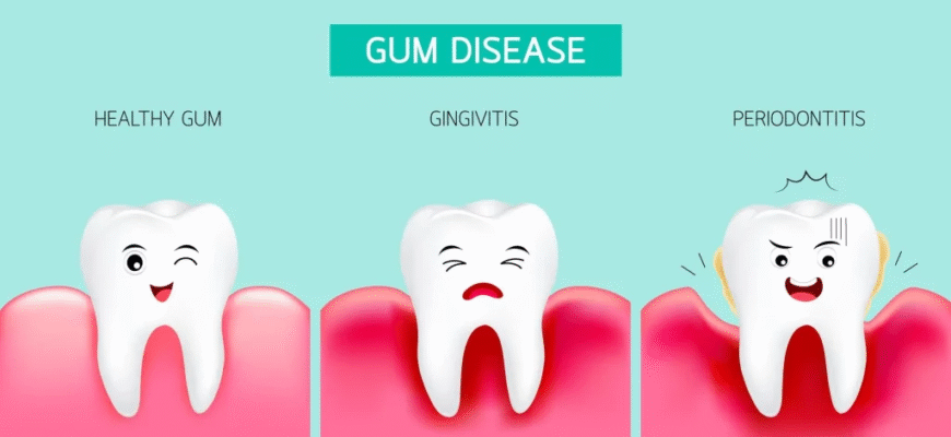Що таке гінгівіт: симптоми, причини та методи лікування Що таке гінгівіт: симптоми, причини та методи лікування