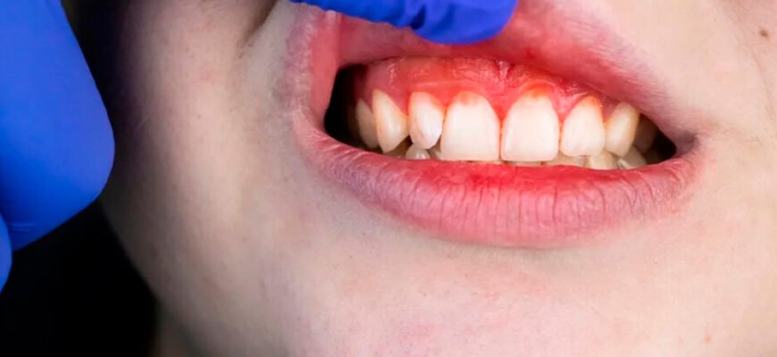 Гінгівіт у дитини 1 рік: ефективні методи лікування в домашніх умовах Гінгівіт у дитини 1 рік: ефективні методи лікування в домашніх умовах