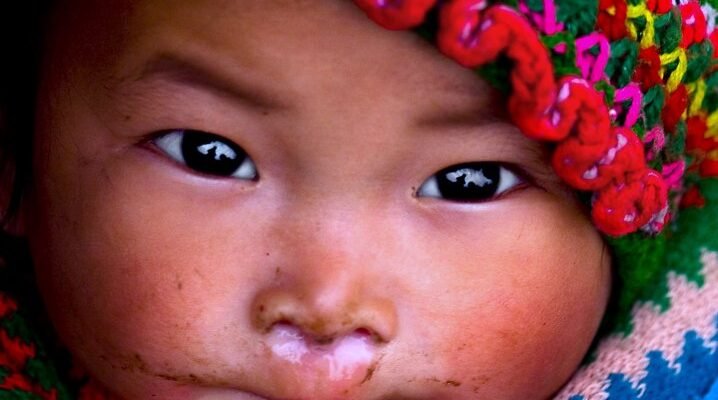 Що таке нежить: причини, симптоми та способи лікування нежитю