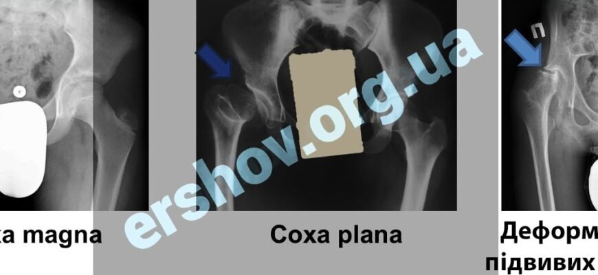 Хвороба Пертеса у дітей: ефективні методи лікування
