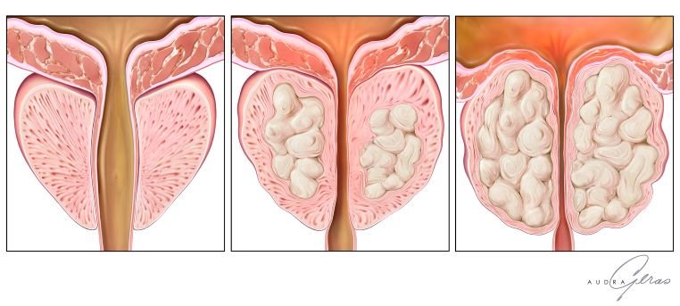 Фіброзні зміни передміхурової залози: причини, симптоми та лікування