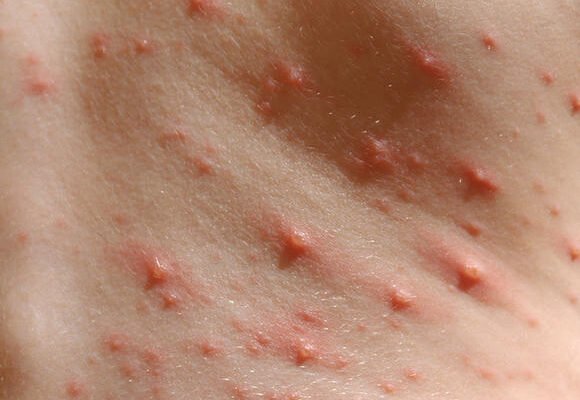 Як виглядає алергічна висипка у дитини: ознаки та симптоми