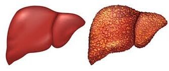 Симптоми жирової хвороби печінки: як вчасно виявити ризики?