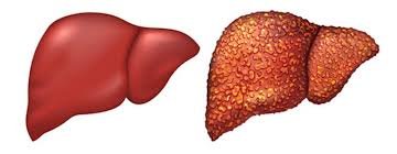 Симптоми жирової хвороби печінки: як вчасно виявити ризики? Симптоми жирової хвороби печінки: як вчасно виявити ризики?