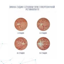 Гіпертонічна хвороба 2 ступеня ризик 3: симптоми та лікування Гіпертонічна хвороба 2 ступеня ризик 3: симптоми та лікування