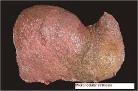 Чи можна вилікувати фіброз печінки: сучасні методи та підходи