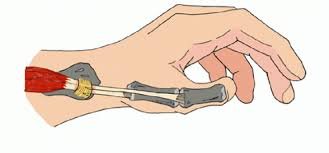 Лікування хвороби де Кервена: ефективні методи та підходи Лікування хвороби де Кервена: ефективні методи та підходи