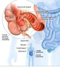 Хвороба Крона у дітей: симптоми, діагностика та лікування